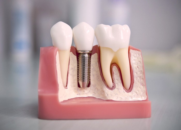 О дентальной имплантации зубов